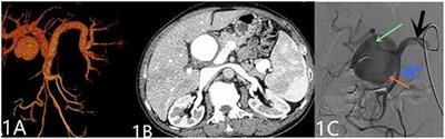 Open Repair of Large Hepatic Artery Pseudoaneurysm Without Collateral Circulation: A Case Report